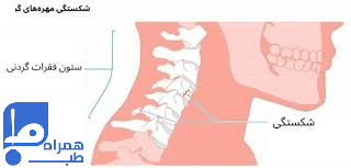 شکستگی گردن 